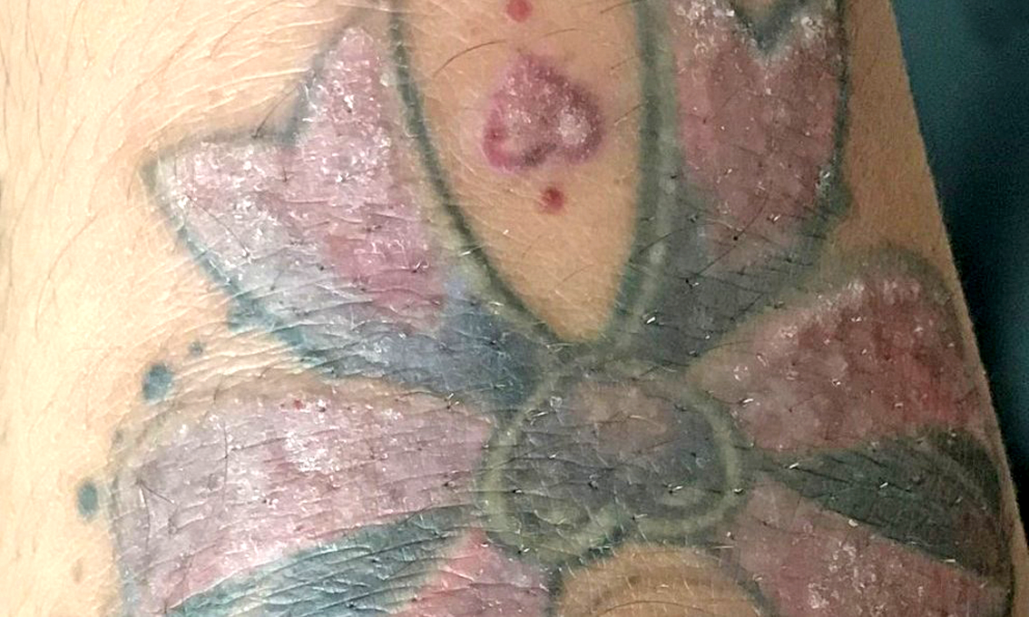 hinh-xam-bi-ngua-nguyen-nhan-va-cach-xu-ly-dung-cach-cho-nguoi-moi-xam